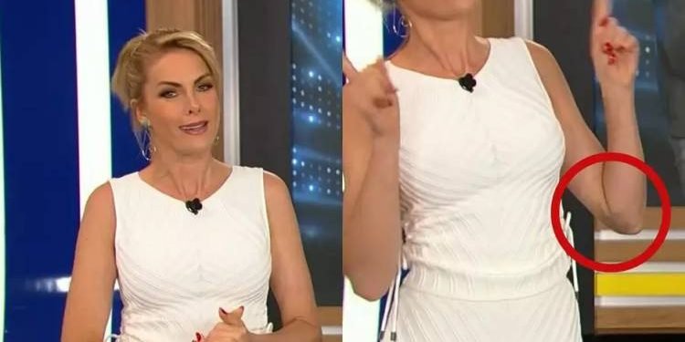 Ana Hickmann Apresenta Hoje Em Dia Com Vestido Que Mostra Hematoma No